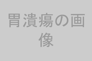 胃潰瘍の内視鏡画像