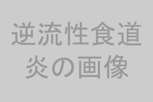 逆流性食道炎の内視鏡画像