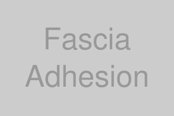 筋膜癒着のイメージ図