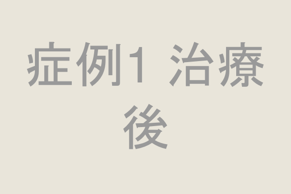 症例1 治療後の口腔内写真