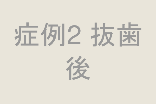 症例2 抜歯後の口腔内写真