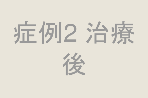 症例2 治療後の口腔内写真